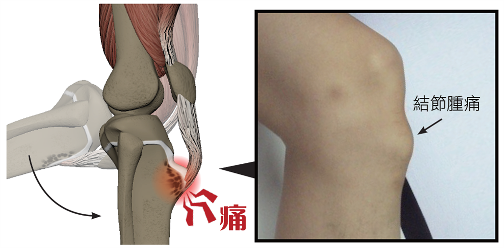髕腱炎